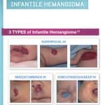 derm expert brochure for Hemangeol